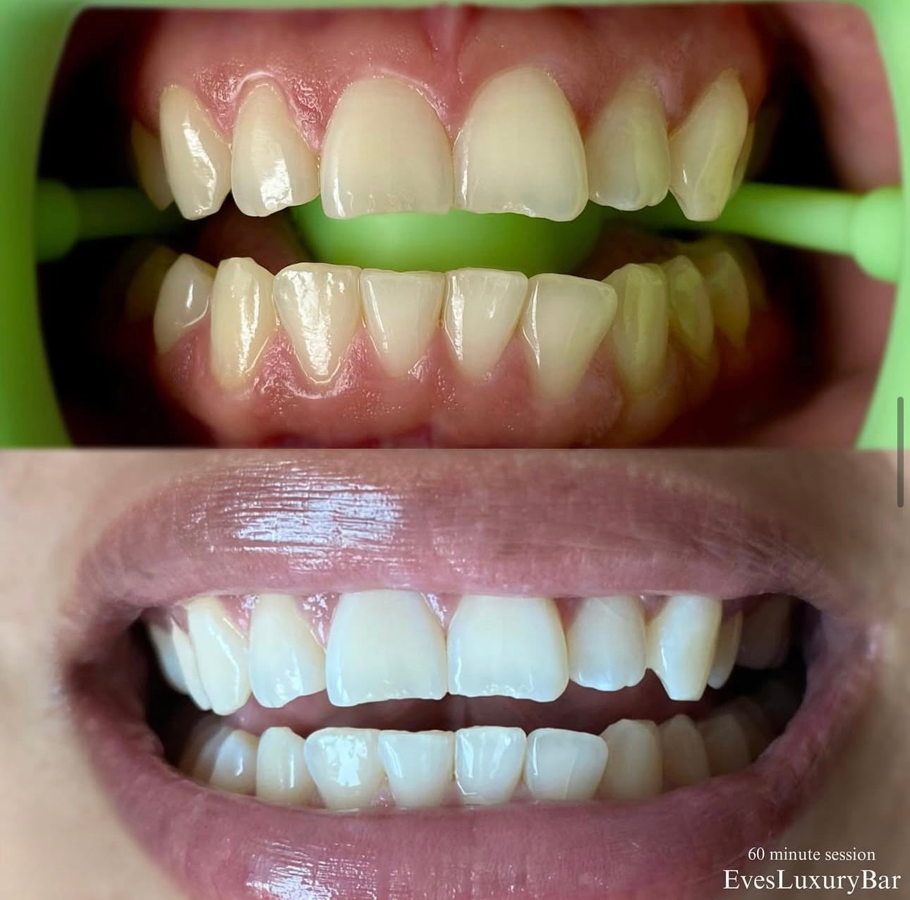 Gel blanco cristal 45% CP