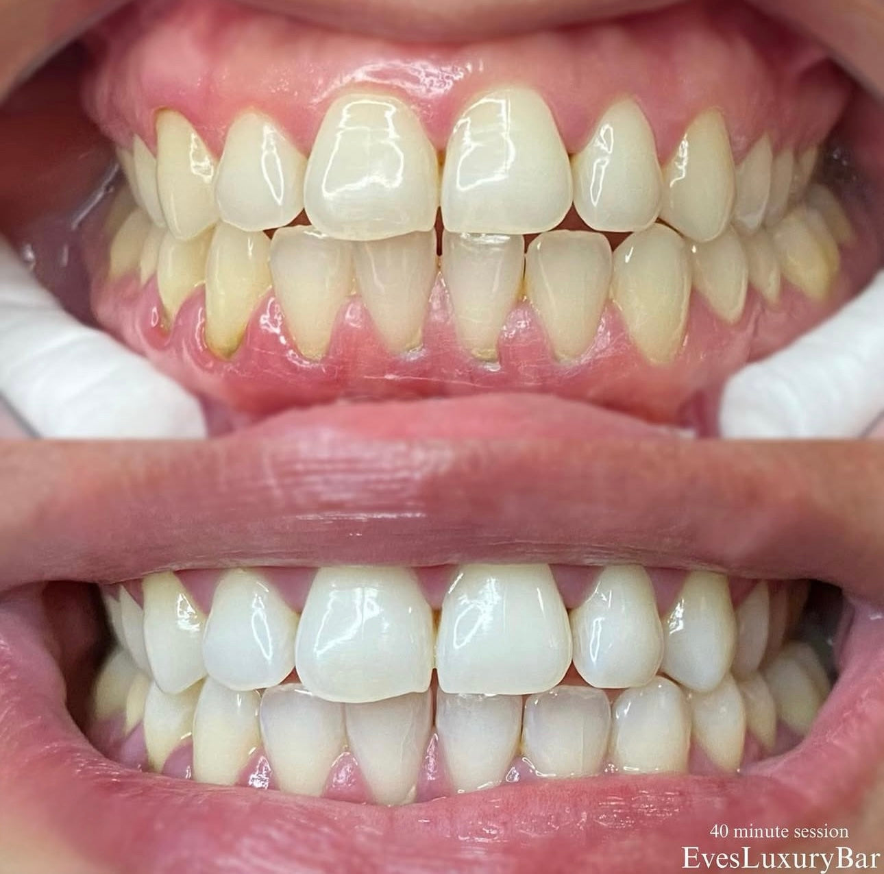 Gel blanco cristal 45% CP