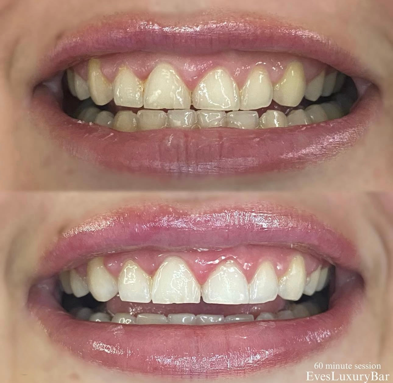 Gel blanco cristal 45% CP